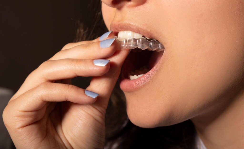 How To Remove Super Glue From Retainer