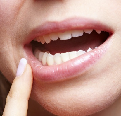 What to Do if Superglue Gets on your Teeth
