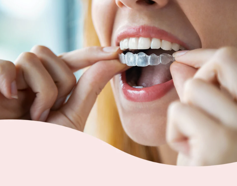 How To Remove Super Glue From Retainer Best Guides Ever